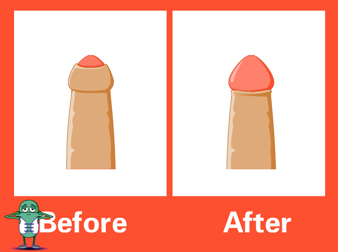 國際精雕包皮整形術(shù)